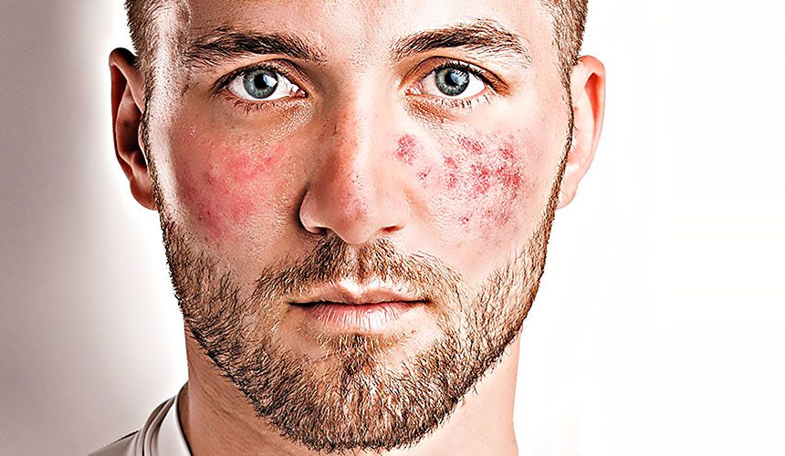 Tratamiento laser rosacea