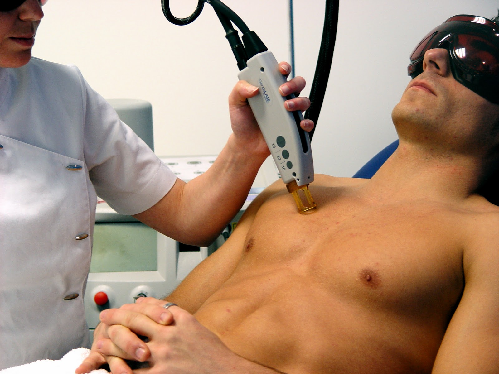 depilacion-laser-masculina