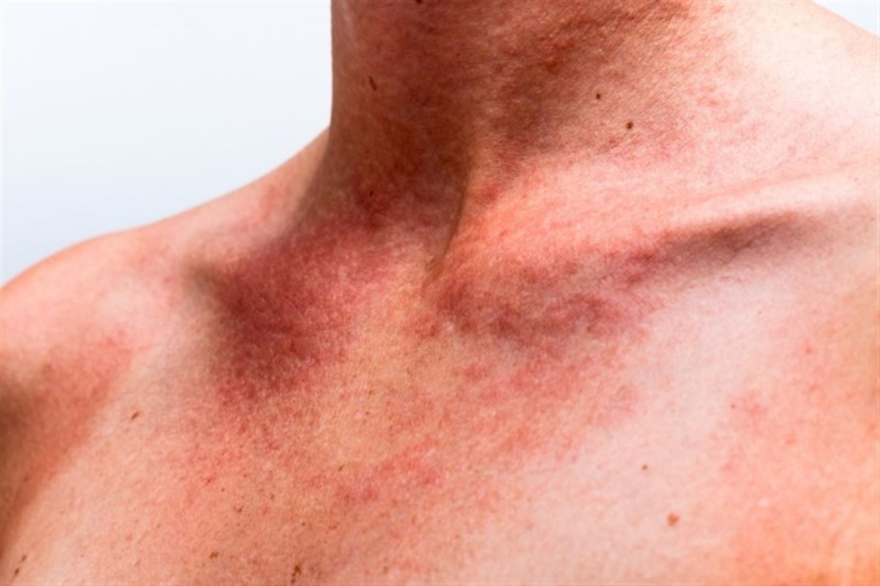 RADIACIÓN SOLAR síntesis de Vitamina D