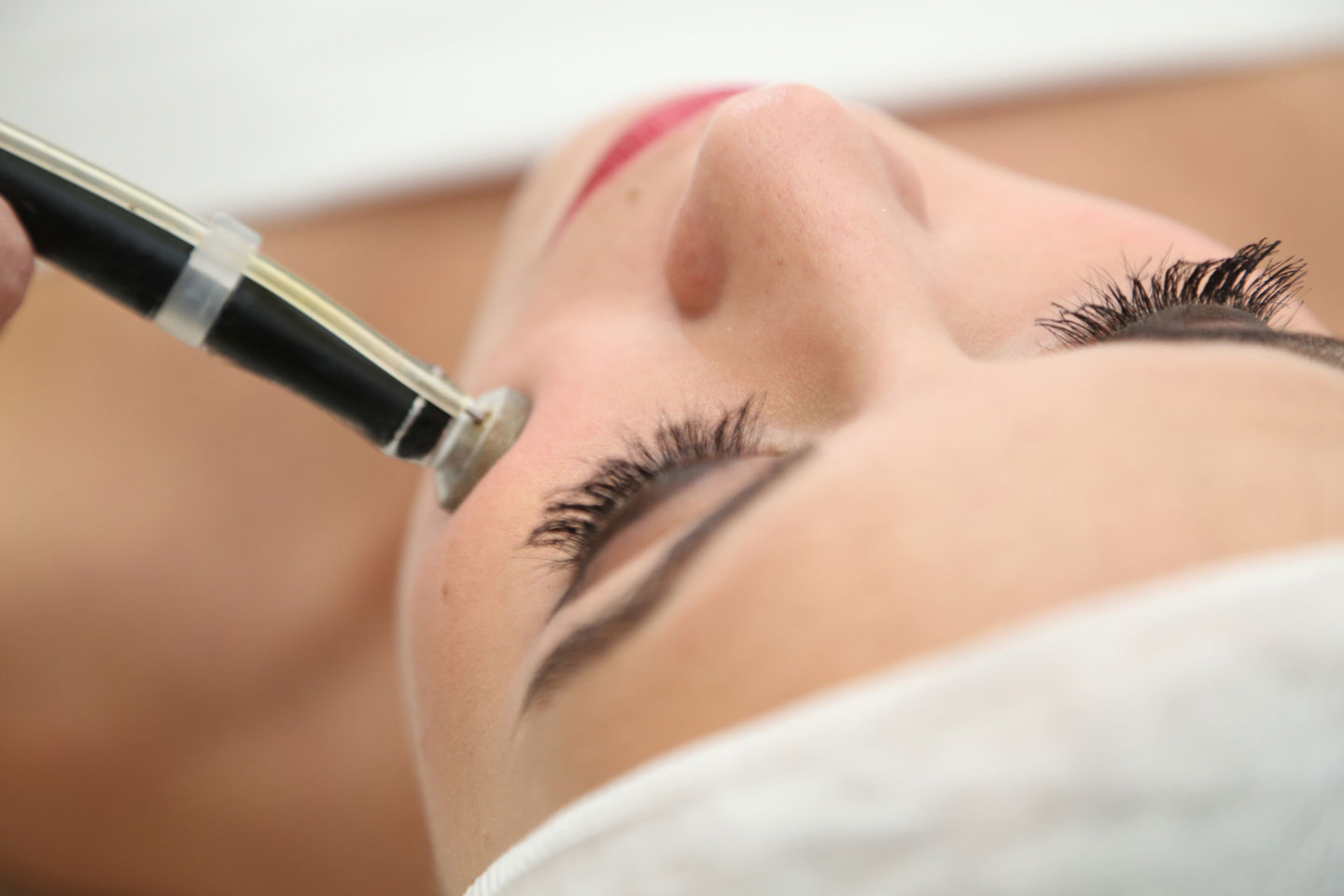 microdermoabrasion micro dermo abrasion santiago inderma estoril chile tratamiento